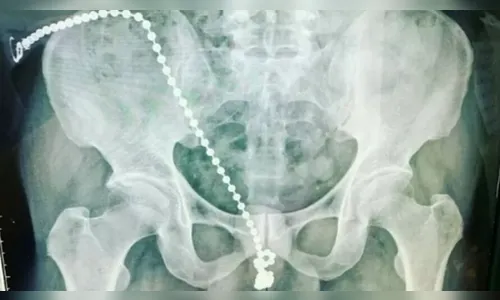 Taiwan: Homem passa por cirurgia para retirar corrente de bolinhas