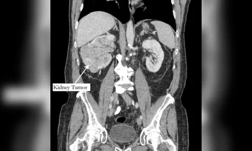 Homem vai tratar dor no dedão do pé e descobre tumor em fase terminal