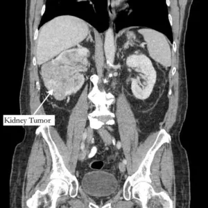 Richard Bernstein foi diagnosticado com um tumor no rim e um trombo tumoral