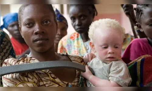 Pai é preso por tentar vender os três filhos albinos para feitiçaria