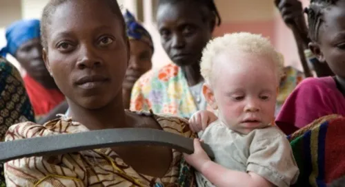 Albinos enfrentam discriminação e ataques no sul da África