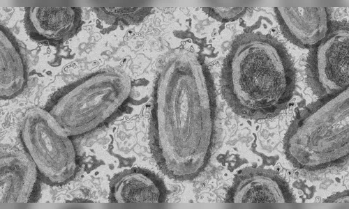 Maringá registra primeiro caso de Monkeypox fora da capital do Paraná