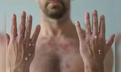 Cientistas alertam para novos sintomas da varíola dos macacos