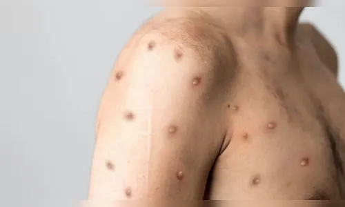 OMS: varíola dos macacos se torna emergência de saúde global