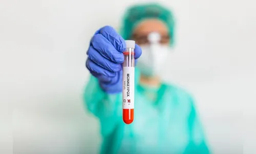 Saúde de Maringá investiga 1º caso suspeito de varíola dos macacos