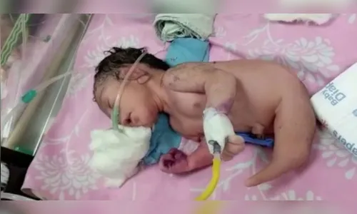 'Bebê-sereia' não é menino nem menina e intriga médicos