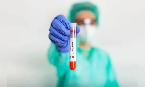 Alerta: Londrina confirma primeiro caso de varíola dos macacos