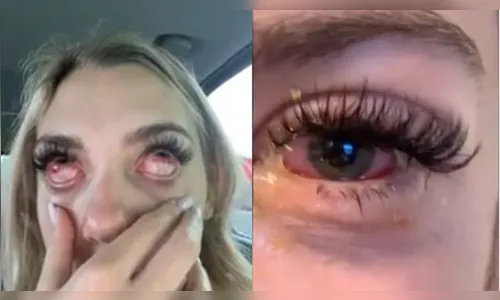 Após extensão de cílios, jovem fica com 'olhos de zumbi'; entenda