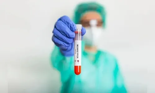 Com 31 casos confirmados, monkeypox se espalha para o interior