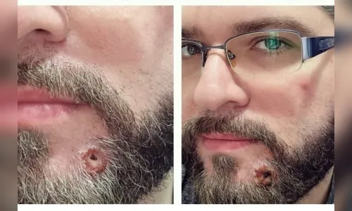 'Dores e incertezas', diz jornalista ao desabafar sobre monkeypox