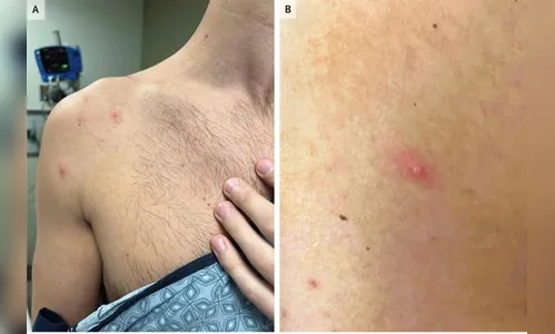 Homem é diagnosticado com HIV, Covid e varíola do macaco; entenda