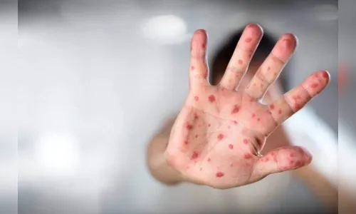 'Gripe do tomate' já infectou 82 crianças na Índia; Conheça a doença