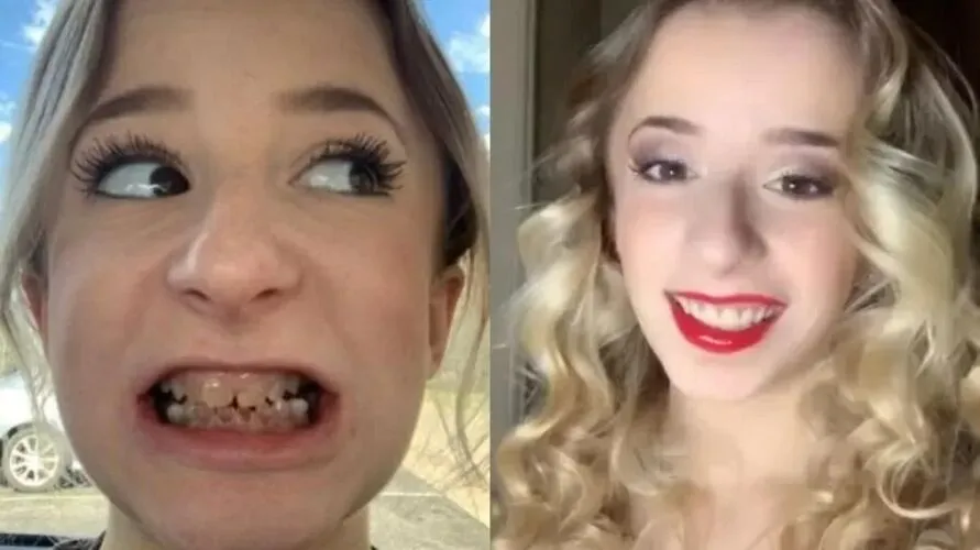 Jovem de 19 anos usou redes sociais para mostrar mudança após cirurgia de implantes nos dentes.
