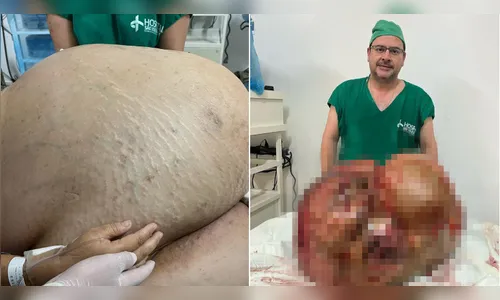 Mulher pensou que estava engordando, mas tinha tumor de 46 kg