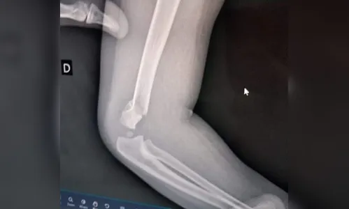 Bebê volta para casa com braço quebrado e família acusa professora