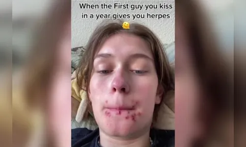 Jovem beija na boca pela primeira vez em um ano e contrai herpes grave