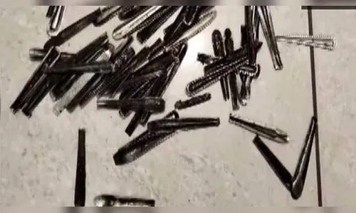 Médicos retiram 62 colheres do estômago de paciente em cirurgia