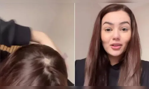 Eslovênia afirmou que vai procurar uma dermatologista para tratar o problema