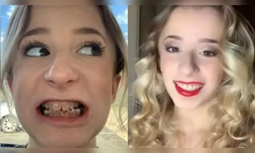 Jovem com dentes 'transparentes' gasta R$ 49 mil para ter novo sorriso