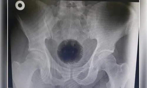 Homem passa por cirurgia para retirar bola de 7 cm do ânus