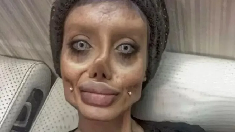 A mulher afirmava que tinha feito mais de 50 cirurgias para se parecer com a atriz Angelina Jolie