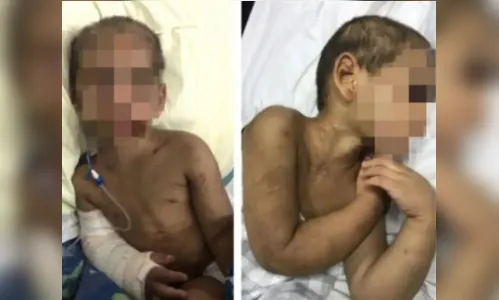 Menino de 5 anos tem oito costelas fraturadas por 'bagunçar demais'