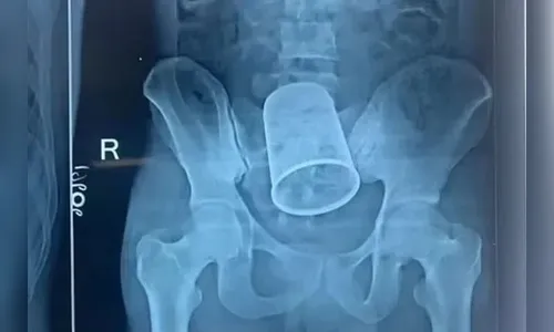 Homem passa por cirurgia para retirar copo de metal do corpo