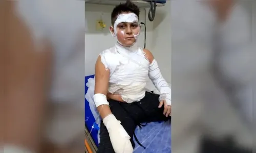 PR: criança sofre queimaduras graves após mangueira de fogão explodir