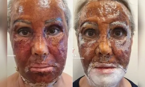 O peeling com fenol é realizado pelo dermatologista, enquanto o paciente está sedado e com anestesia local na região do rosto