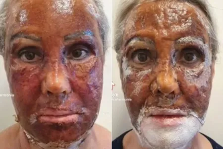 O peeling com fenol é realizado pelo dermatologista, enquanto o paciente está sedado e com anestesia local na região do rosto