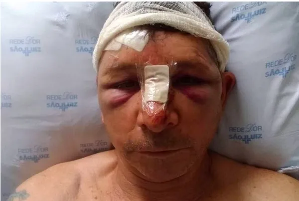 Devido ao acidente, Carlos quebrou o nariz e o maxilar