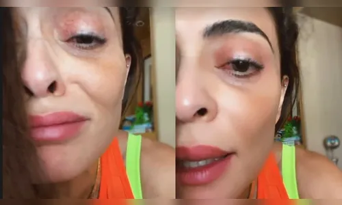 Juliana Paes surge com o olho inchado e lamenta: 