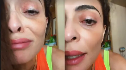 A atriz Juliana Paes (43), usou as redes sociais na noite da última sexta-feira, 02, para contar aos fãs o motivo de estar com o olho inchado