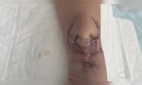 Médicos cultivam nariz em braço de paciente que perdeu órgão