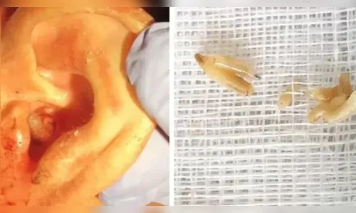 Larvas 'carnívoras' são achadas dentro da orelha de homem; saiba mais