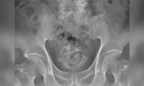 Médicos encontram corda de pular enrolada na bexiga de paciente