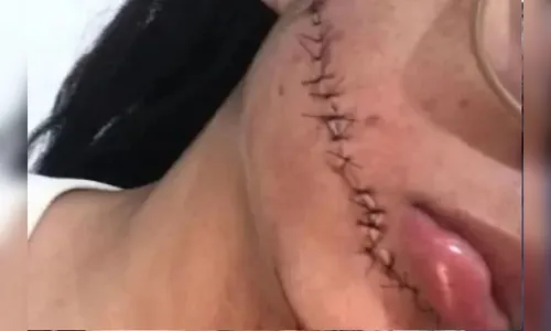 Jovem leva facada no rosto durante viagem de ônibus