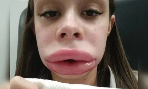 Mulher descobre doença rara após preenchimento nos lábios; veja