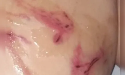 Mãe é presa por torturar filha de 8 anos com galho de jabuticabeira