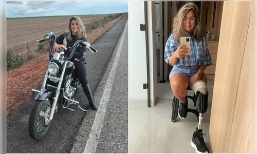 Servidora tem parte dos membros amputados após infecção por lipo