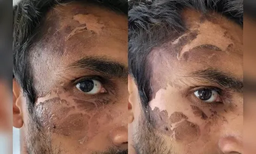Homem é condenado após jogar água fervente no rosto de policial