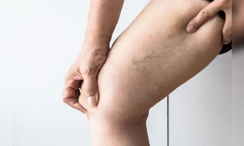 Tratamento de varizes sem cortes, tecnologia substitui cirurgia