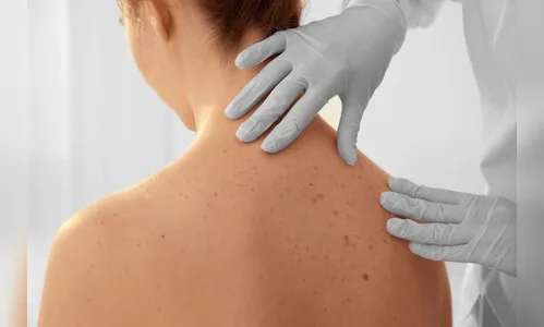 Especialista de Apucarana orienta sobre câncer da pele; veja