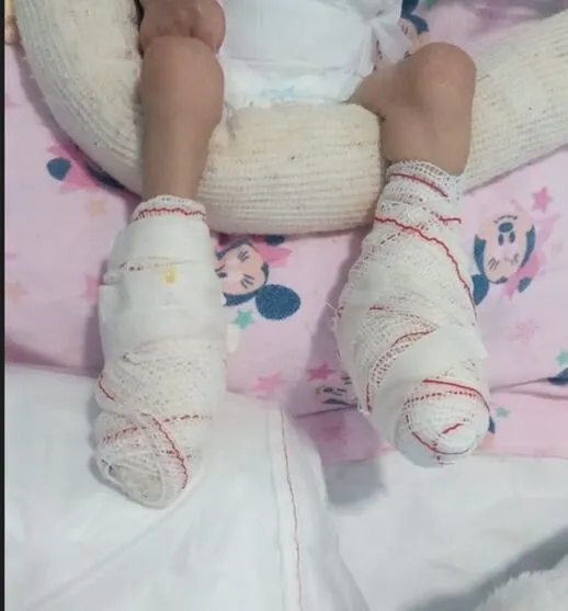 A pequena teve os pés queimados por um aquecedor que foi esquecido ligado em um hospital
