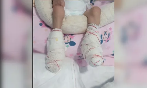Bebê que teve os pés queimados por aquecedor em hospital morre