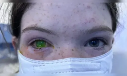 Doença que deixa olho verde e 'dói como parto' gera alerta; entenda
