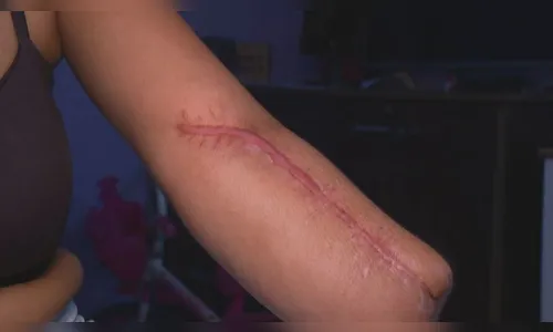 Mulher dá entrada em hospital para dar à luz e sai com mão amputada