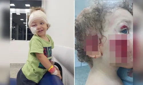 Menino fica com rosto dilacerado ao ser atacado pelo cachorro da babá