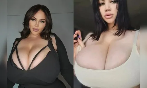 Modelo tem condição rara em que seios não param de aumentar