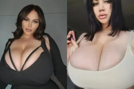 Pamelia James, que é modelo da OnlyFans, já havia buscado ajuda médica por conta de dores nas costas, pescoço e ombros devido ao peso de seus seios